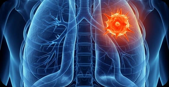 Non-Small Cell Lung Cancer (NSCLC)