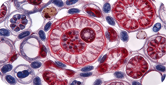 Non-Hodgkin Lymphoma (NHL)