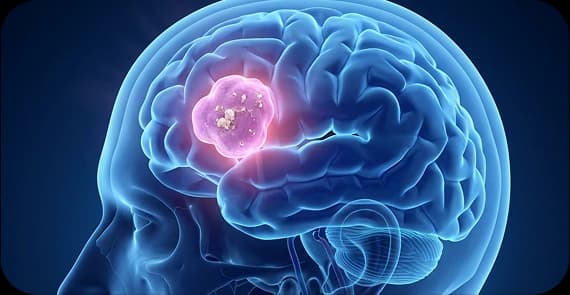   Oligodendroglioma 