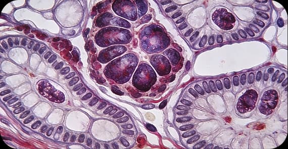 Basal Cell Carcinoma