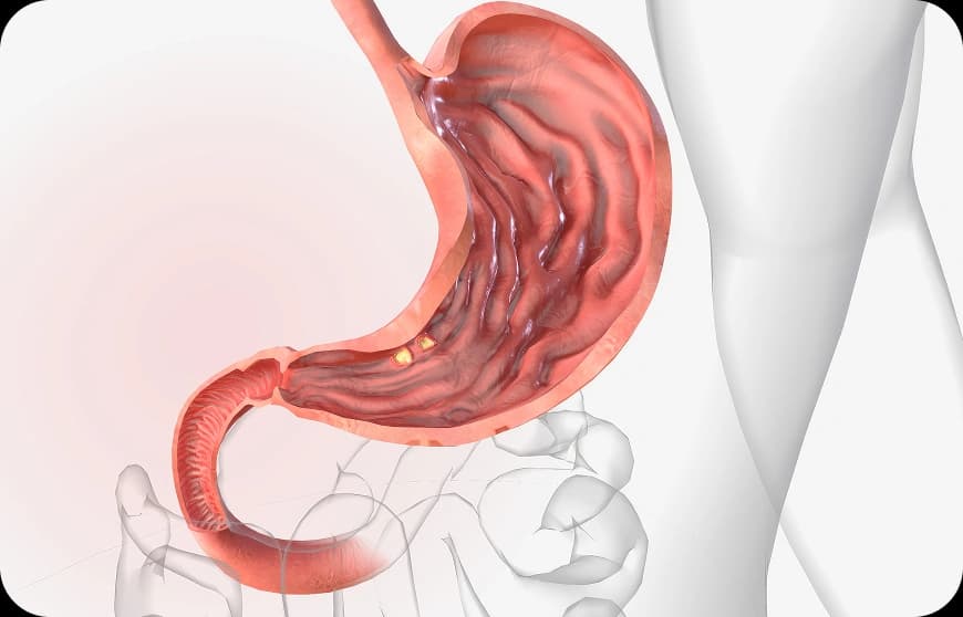 Risk Factors for Stomach Cancer