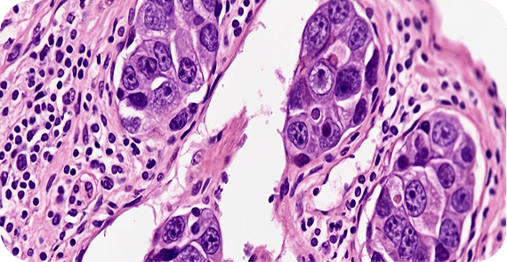 Inflammatory Breast Cancer
