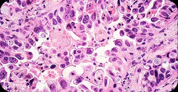 Adenocarcinoma