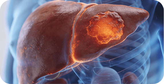 Hepatocellular Carcinoma (HCC)