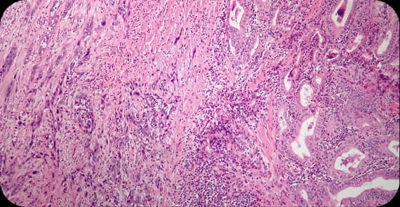 Anaplastic Thyroid Cancer