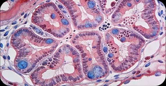 Adenocarcinoma