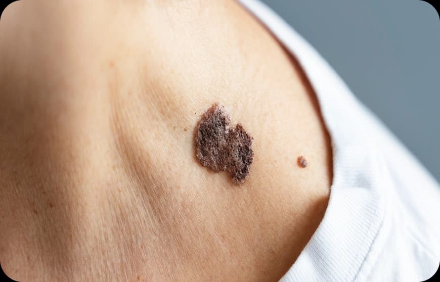 Risk Factors for Sarcoma Cancer