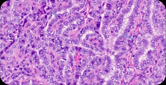 Papillary Thyroid Cancer