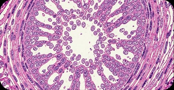 Squamous Cell Carcinoma 
