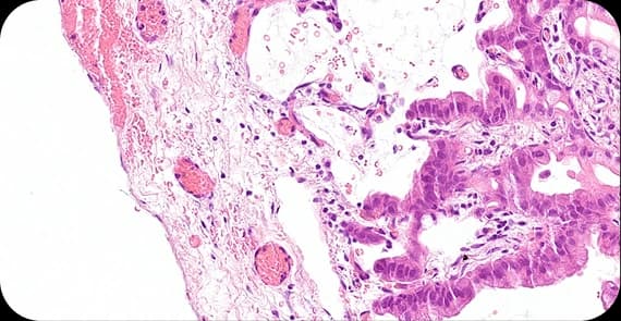 Mucinous Adenocarcinoma