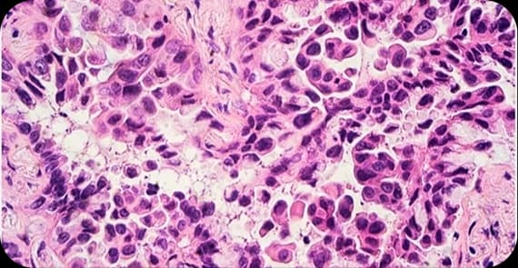 Small Cell Lung Cancer (SCLC)