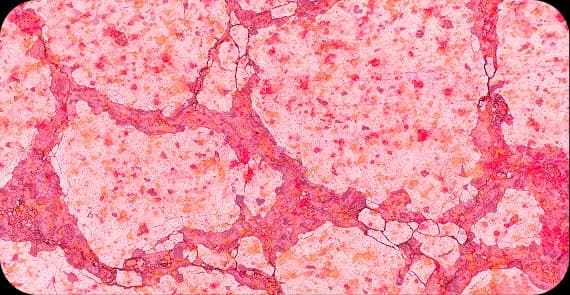 Squamous Cell Carcinoma