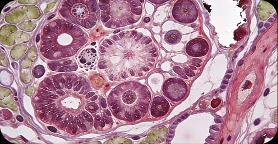 HPV-Associated Oropharyngeal Cancer