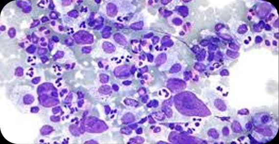 Hodgkin Lymphoma