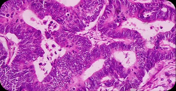 Adenocarcinoma