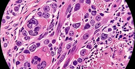 Anaplastic Thyroid Cancer 