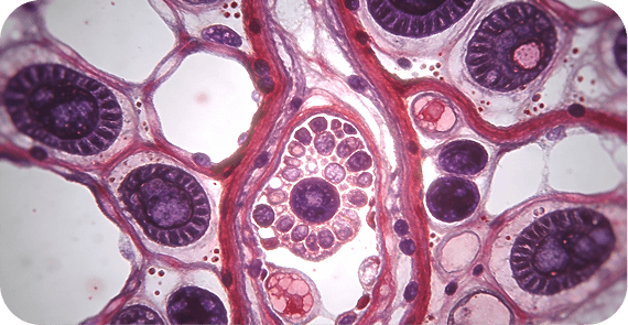 Angiosarcoma
