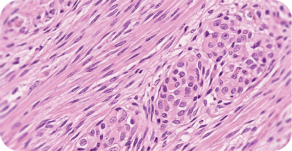 Gastrointestinal Stromal Tumours (GISTs)