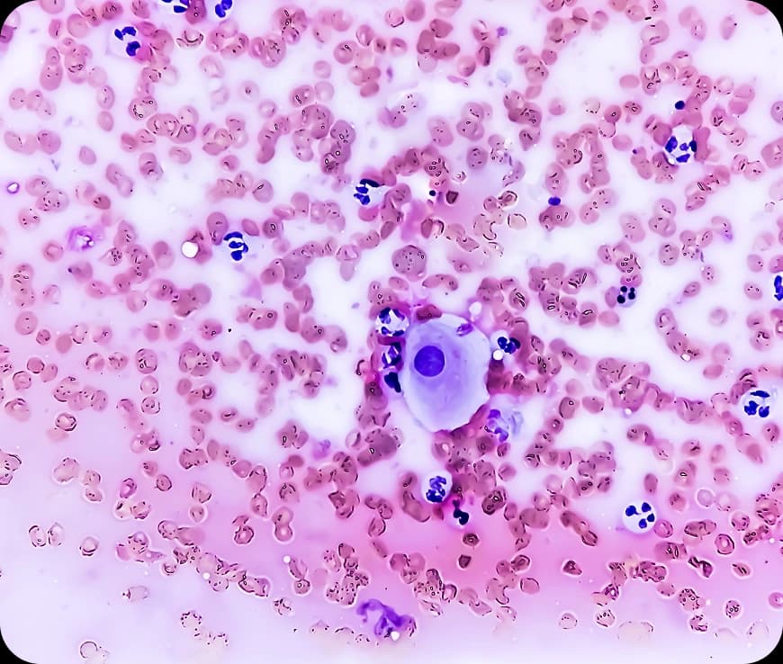 Uterus Cancer Stages Explained