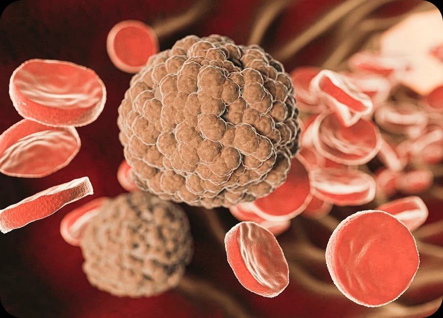Causes of Sarcoma Cancer