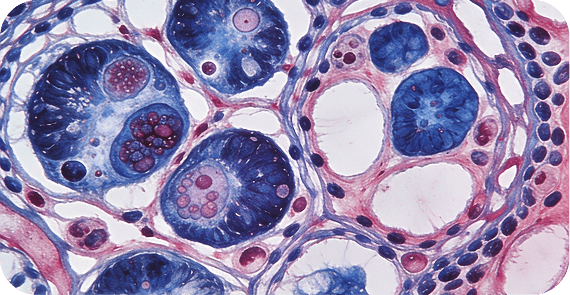CNS Lymphoma
