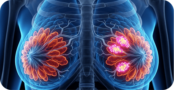 Ductal Carcinoma In Situ (DCIS) 