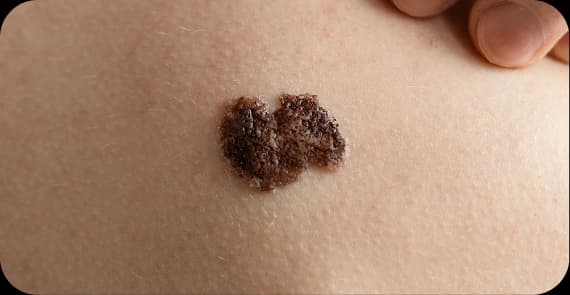 Squamous Cell Carcinoma