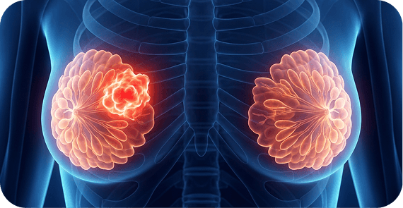 Invasive Ductal Carcinoma (IDC)