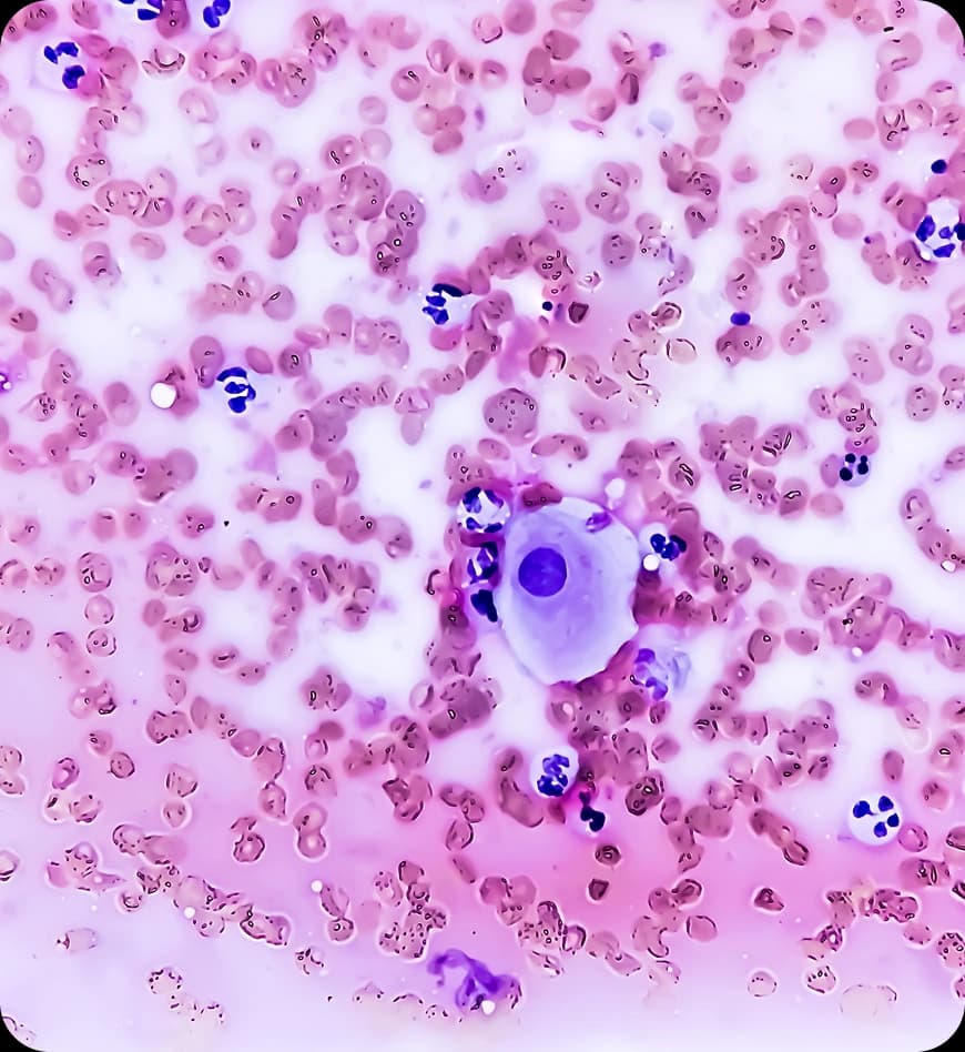 Cervical Cancer Stages Explained