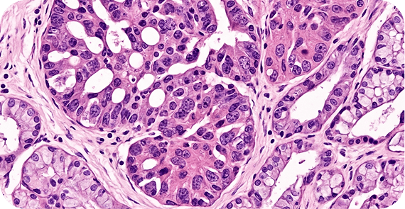 Minor Salivary Gland Carcinoma 