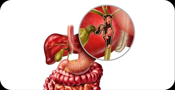 Intrahepatic Cholangiocarcinoma