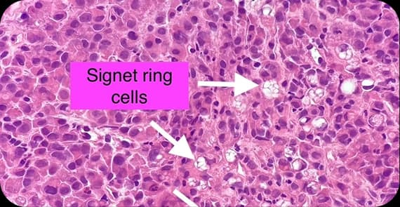 Signet Ring Cell Carcinoma