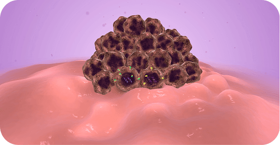 Squamous Cell Carcinoma