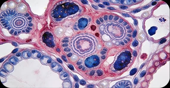 Squamous Cell Carcinoma 