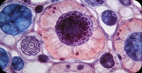 Primary Peritoneal Cancer 