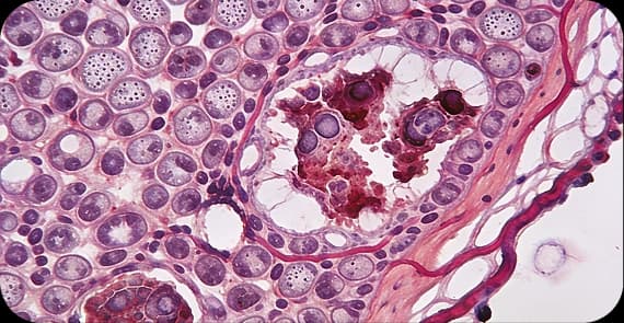 Small Cell Carcinoma 