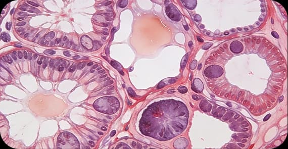Adenocarcinoma