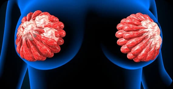 HER2-Positive Breast Cancer