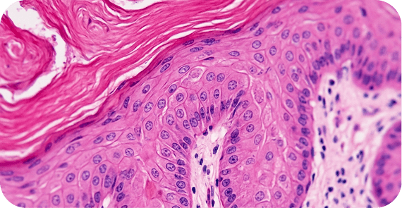 Verrucous Carcinoma
