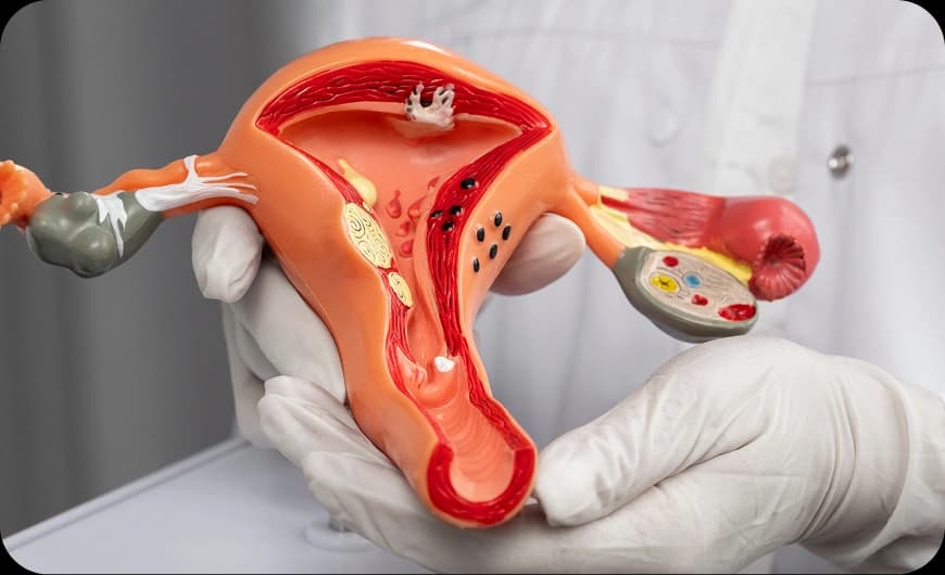 What Is Cervical Cancer?