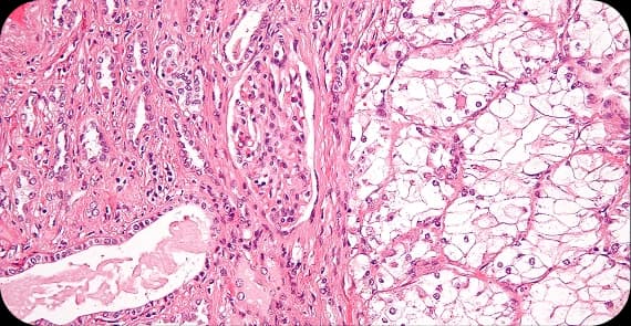 Chromophobe and Other Subtypes