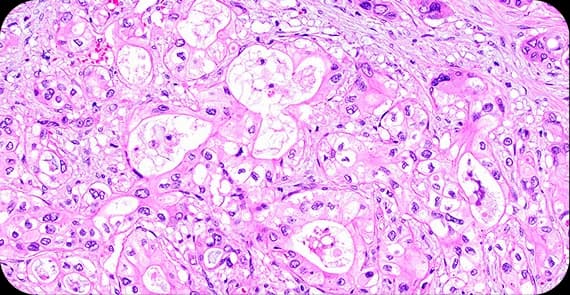 Pancreatic Ductal Adenocarcinoma