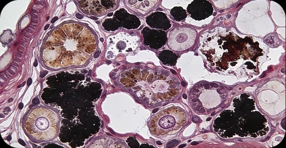 Melanoma
