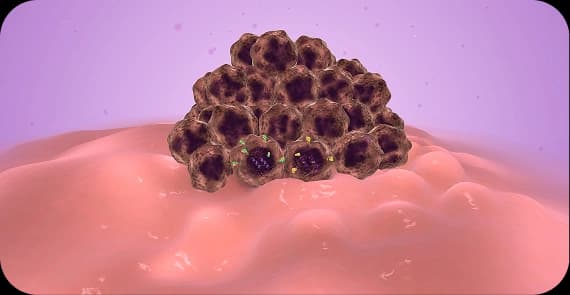 Basal Cell Carcinoma