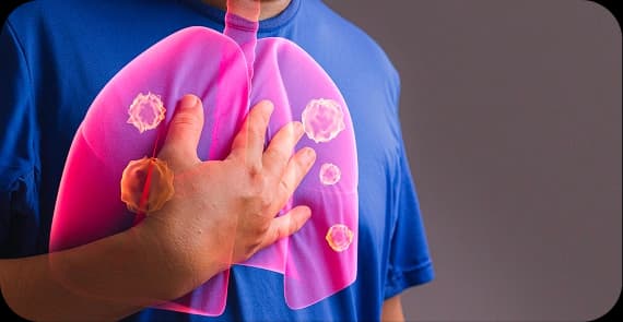 Pleural Mesothelioma