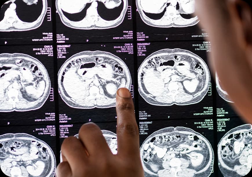 How Is Pancreatic Cancer Diagnosed?