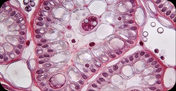 Clear Cell Carcinoma 