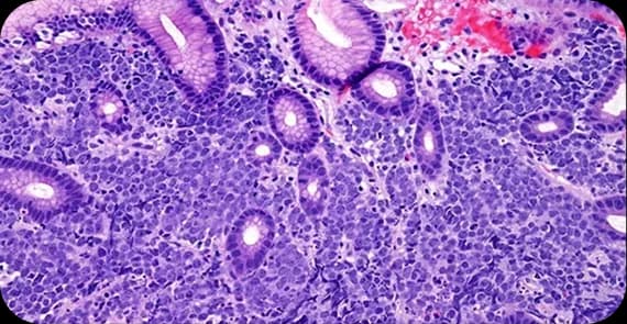 Lymphoma of the Stomach