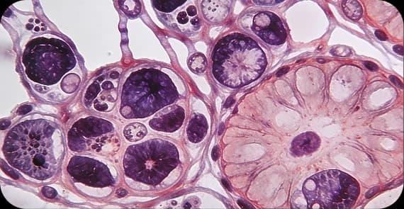 Transitional Cell Carcinoma