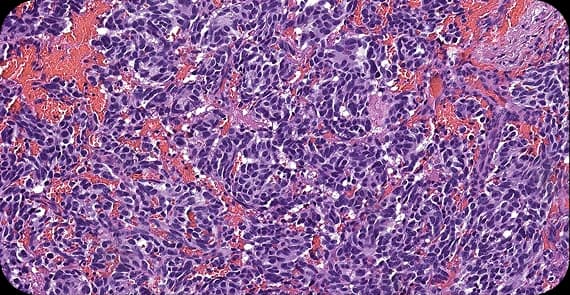 Neuroendocrine Tumours